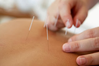 terapi akupunktur