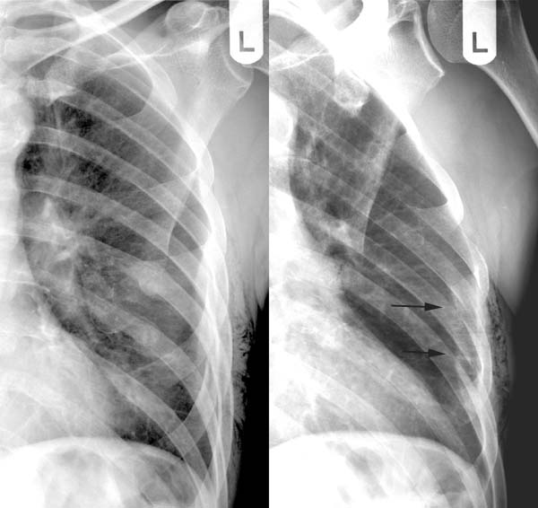 rippe gebrochen Germany News Collections