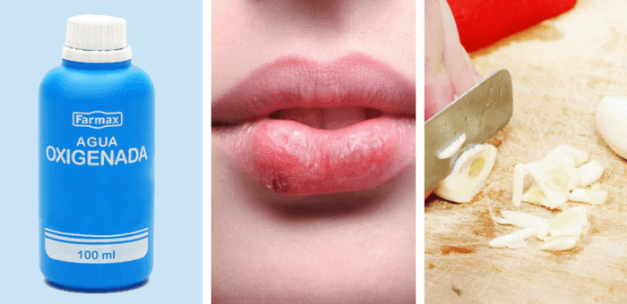 remedios para eliminar el herpes labial