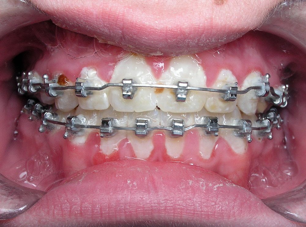 Your Braces Could Be Causing Gum Problems Directorio Odontológico