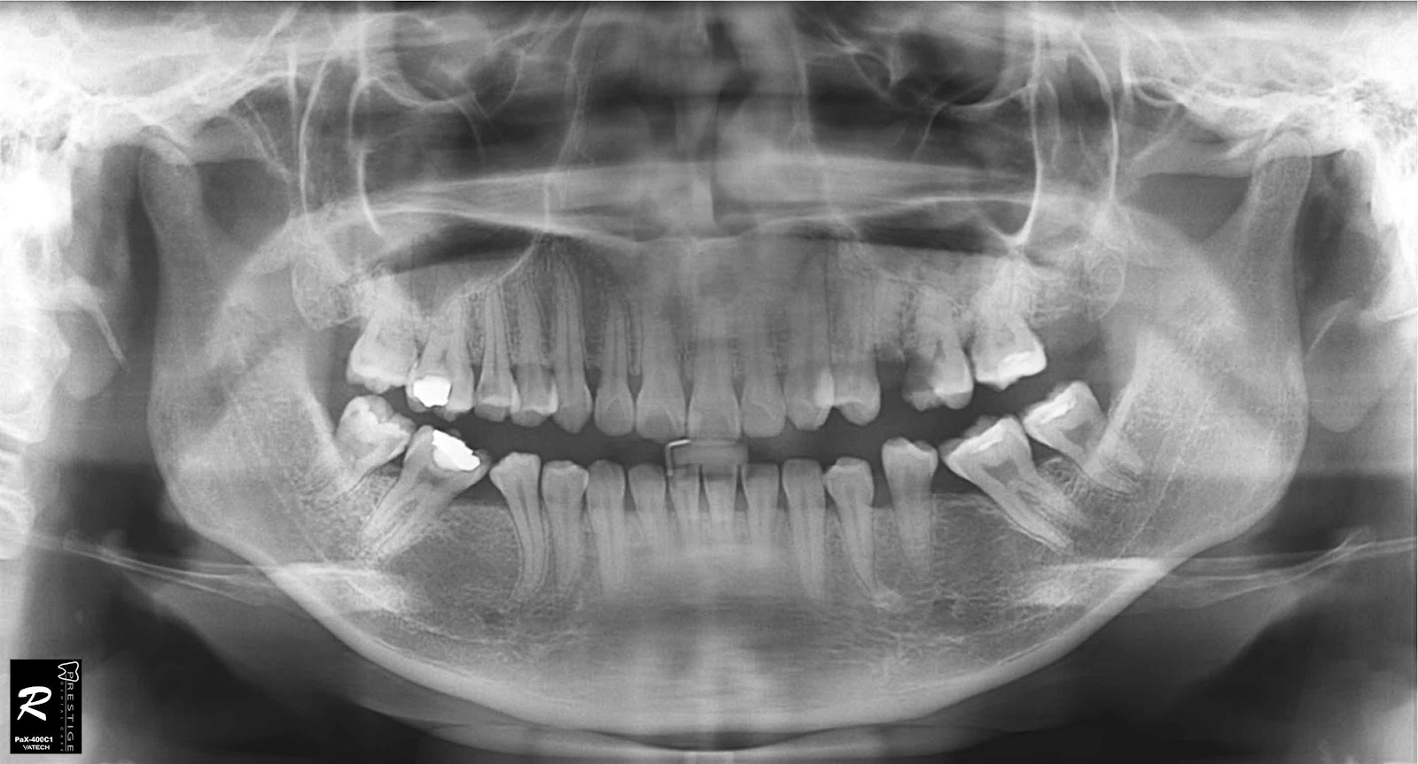 artroza mandibulara preparate pentru îmbunătățirea circulației cerebrale în osteochondroză