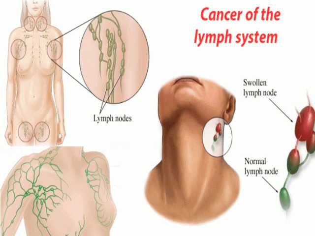 symptoms of neck cancer in lymph node symptoms of neck cancer in lymph node