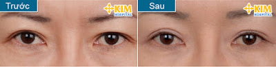 Bỏ túi những cách xóa bọng mỡ mắt an toàn và hiệu quả (3)