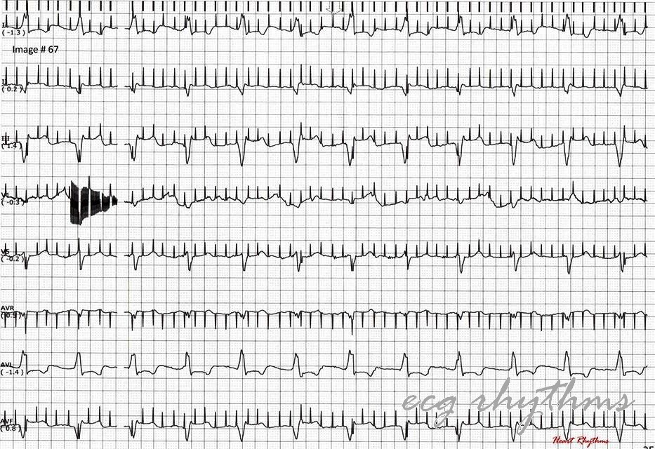 ECG Rhythms Pacer Malfunction?