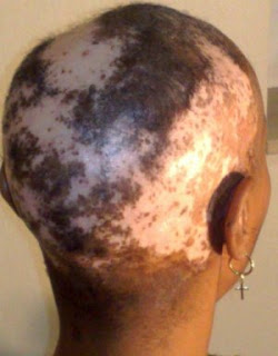 L'alopécie : Un mal à éradiquer