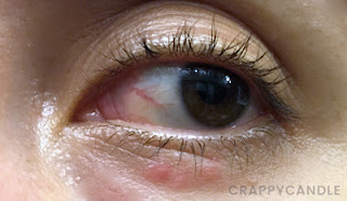 Mild Periocular Dermatitis / Eyelid Rash Flare-up :: Crappy Candle