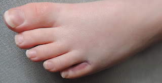 damaged toe and nails that need cutting
