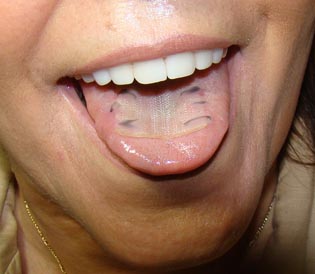 Mallas linguales para bajar de peso Mallas linguales para bajar de peso