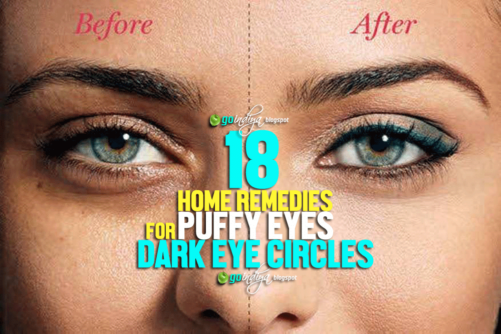 18 Natural Home Remedies for Dark Eye Circles, Puffy Eyes Part 2 Natural Home Remedies