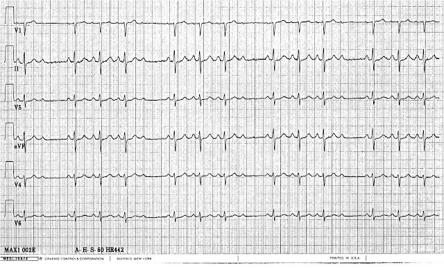 Aritmia; EKG Dokter Alfa Belajar Kedokteran