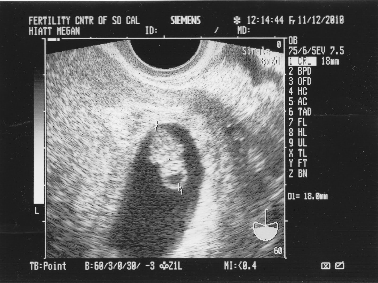 Состояния при 8 неделях. УЗИ 8 недель беременности УЗИ. УЗИ беременности 8 недель беременности. Снимок УЗИ на 7-8 неделе беременности. Эмбрион на 8 неделе беременности УЗИ.