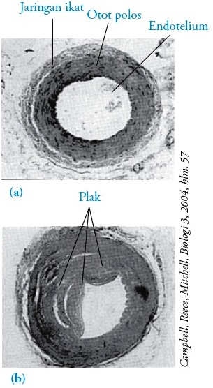 Penyebab Penyakit Jantung Koroner