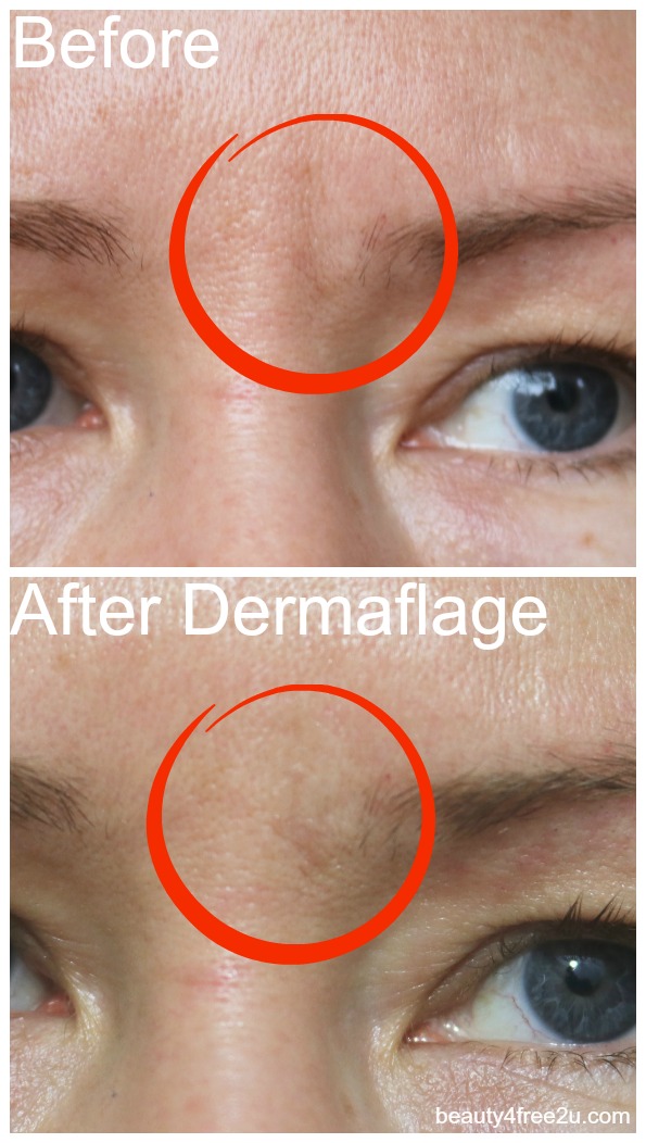 HOW TO GET RID OF FROWN LINES BETWEEN EYES WITHOUT BOTOX noBotox 