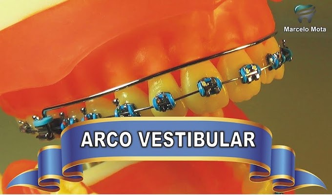 ORTODONTIA: Arco Vestibular Acessório (para expansão dentoalveolar)