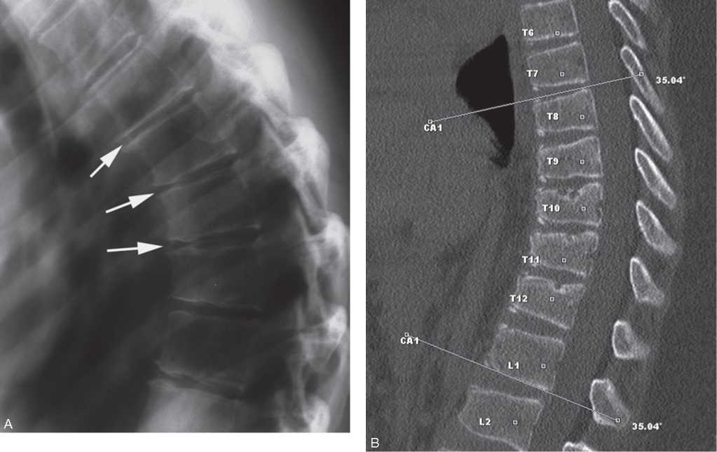 Блог о хирургии позвоночника: Операция при Шейерман-Мау