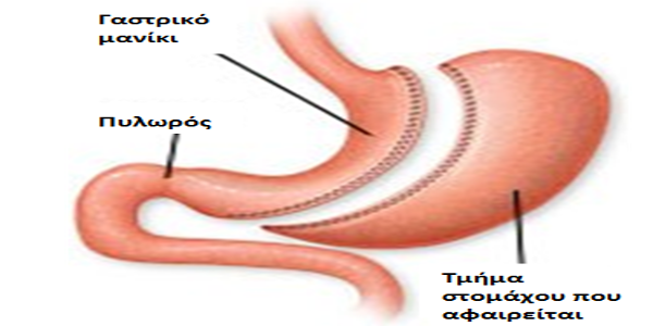 Αποτέλεσμα εικόνας για γαστρικο μανικι