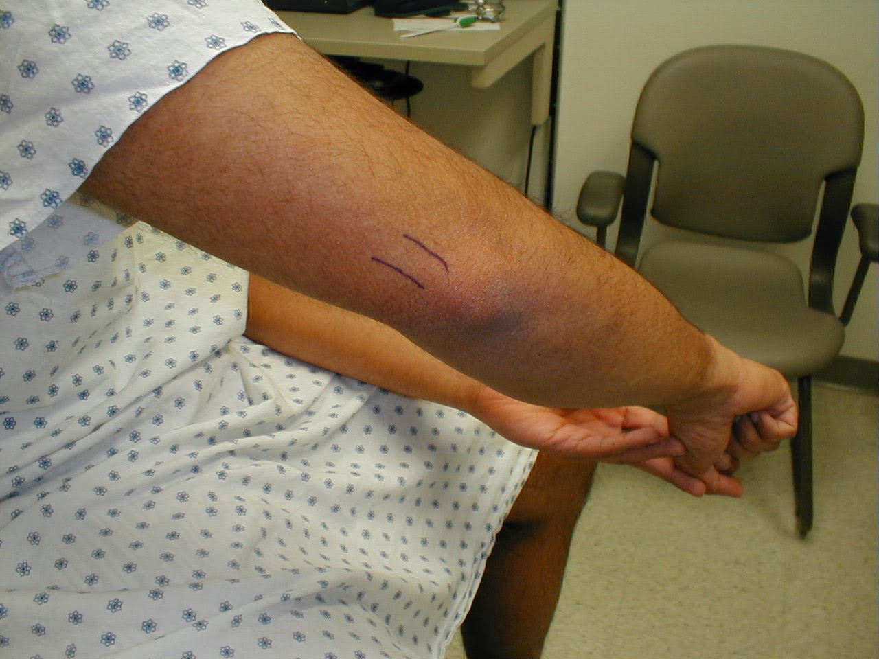 The Amazing Bodybuilding: Tricep Tendonitis