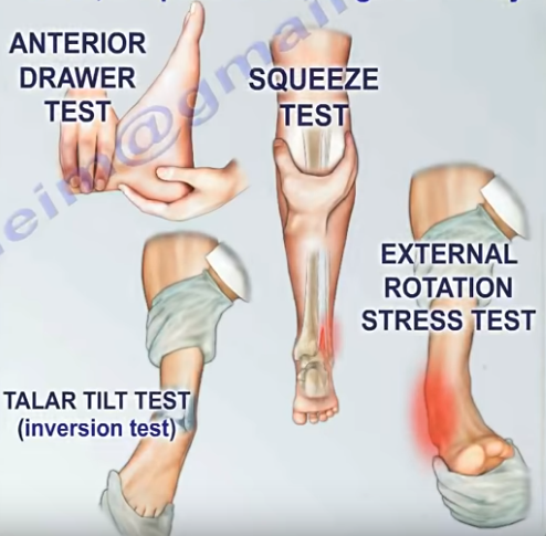 Dr. Nabil Ebraheim's Blogspot: Ankle Ligaments Injury, Tests & Assessment