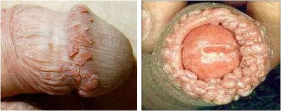 Senile warts: pictures and clinical information