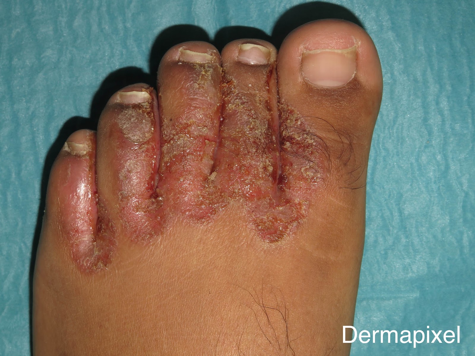Dermapixel Hongos en los pies que se complican
