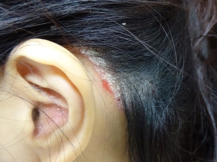 乾癬表現很多樣 正確診斷很重要 照護線上