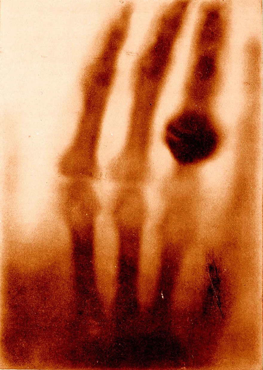 Top 100 Of The Most Influential Photos Of All Time - The Hand Of Mrs. Wilhelm Röntgen, Wilhelm Conrad Röntgen, 189