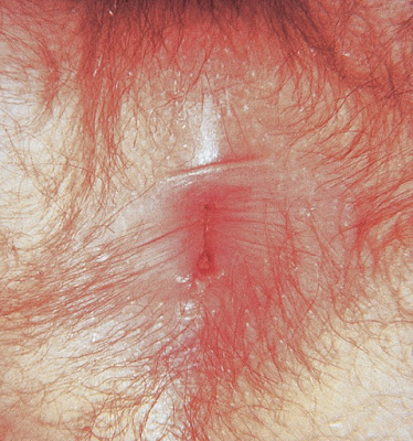 Anal fissure in a man presenting with anal pain and occasional bleeding for 1 week