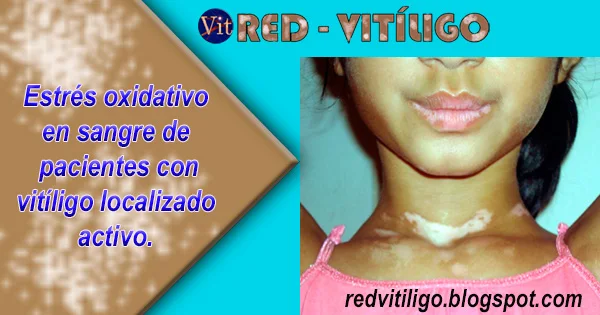 Estrés oxidativo en sangre de pacientes con vitiligo localizado activo.