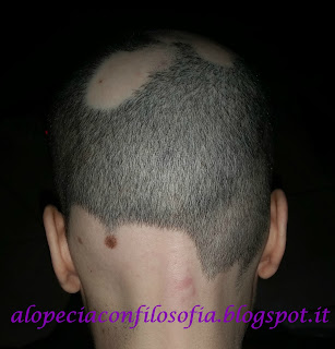 alopeciaconfilosofia, alopecia areata