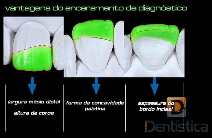 DENTÍSTICA: Restauração de dente anterior fraturado