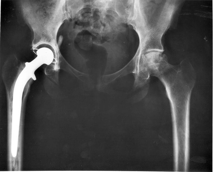 Tom's Physiotherapy Blog Surgery to the Hip