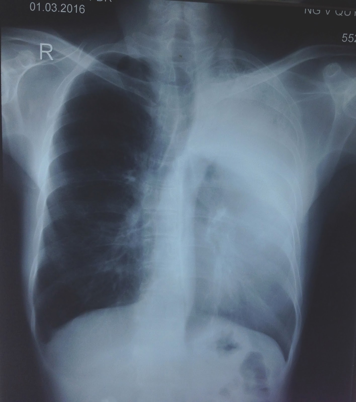 VIETNAMESE MEDIC ULTRASOUND CASE 366 LUNG HEPATIZATION, Dr PHAN