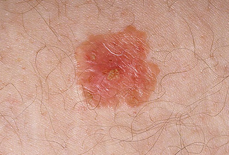 Is it skin cancer? - Is it skin cancer? - Pictures - CBS News