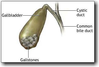 Natural Remedies for Gall Bladder Stones