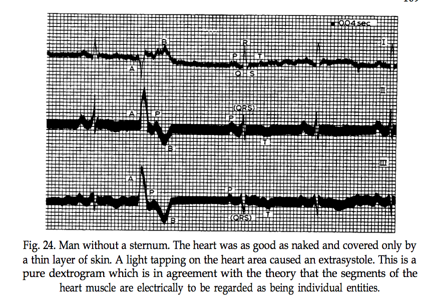 Eugene Shteyn's Blog Invention of the Day Electrocardiography (EKG)