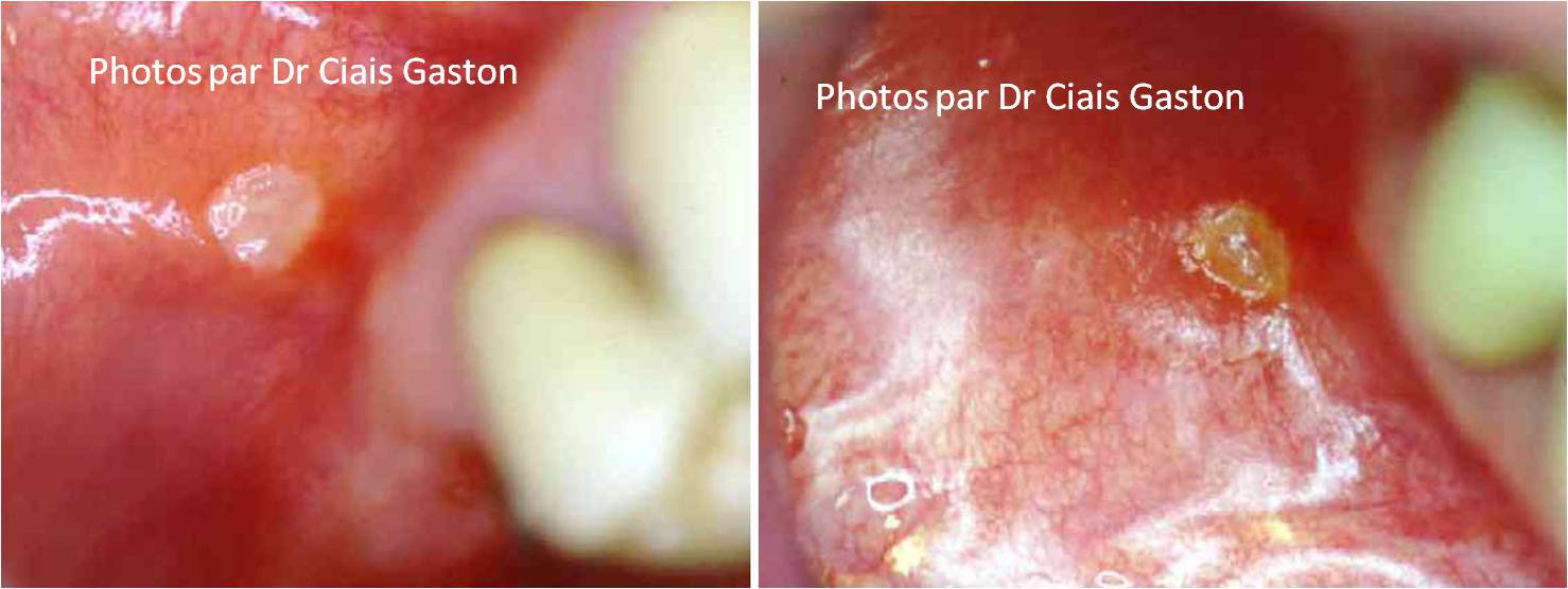 comment traiter aphte