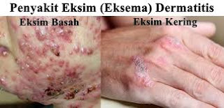 Cara Ampuh Mengatasi Gatal Eksim, Apa Nama Obat Sakit Gatal Karena Eksim Kering?, Bagaimana Mengobati Sakit Eksim Menahun?