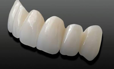 Răng sứ cercon có mấy loại?