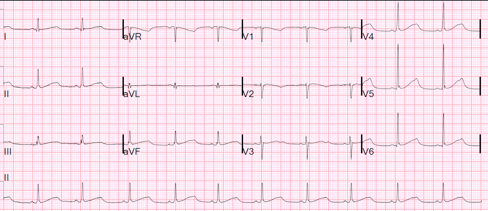 Dr. Smith's ECG Blog Syncope in a 20something woman
