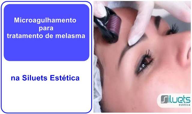 Microagulhamento para tratamento de melasma na Siluets Estética Microagulhamento para tratamento de melasma na Siluets Estética