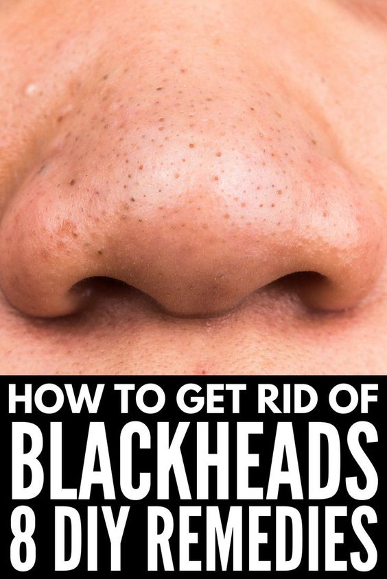 How To Remove Blackheads From Nose TOP 5 DIY