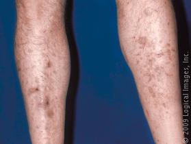 Causes of Dark Spots on Your Legs | LIVESTRONG.COM