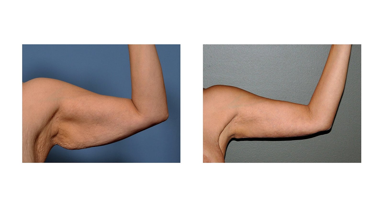 Cost Of Arm Lift Lift Choices