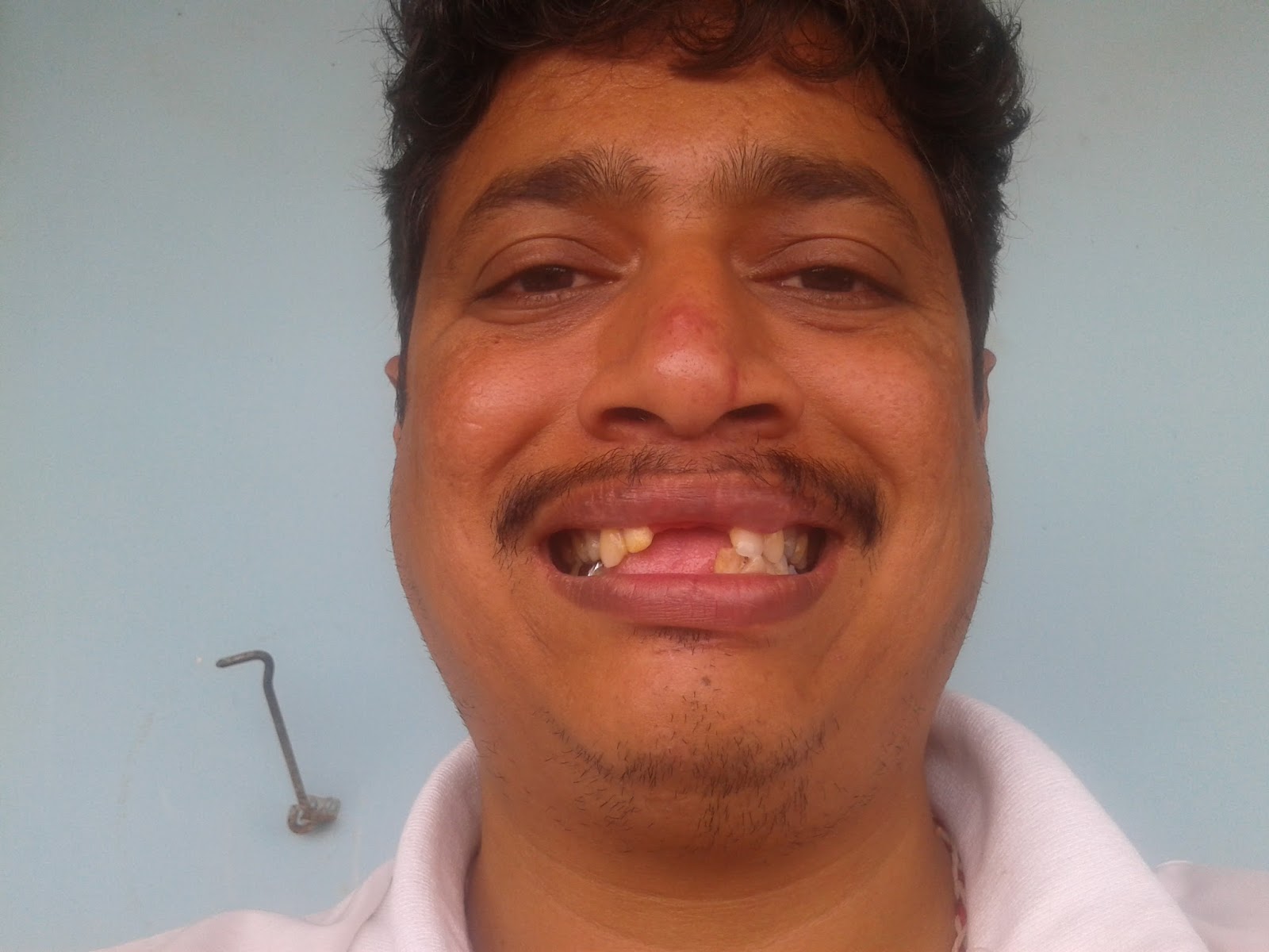 Dental Implants From Canada Save upto 87 in the cost of Dental Implants