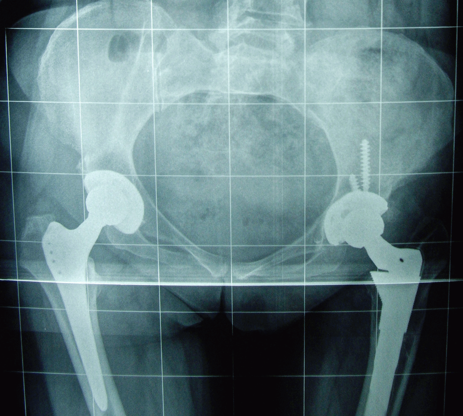 Blog Del Dr Villamor Recuperación Tras Una Prótesis De Cadera Cómo Olvidarse De La Muletas En Dos Meses