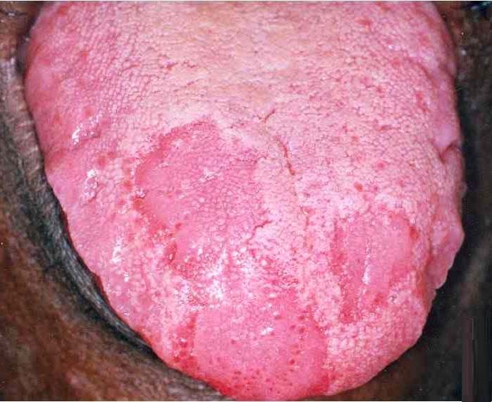 Glossitis Peradangan lidah bengkak