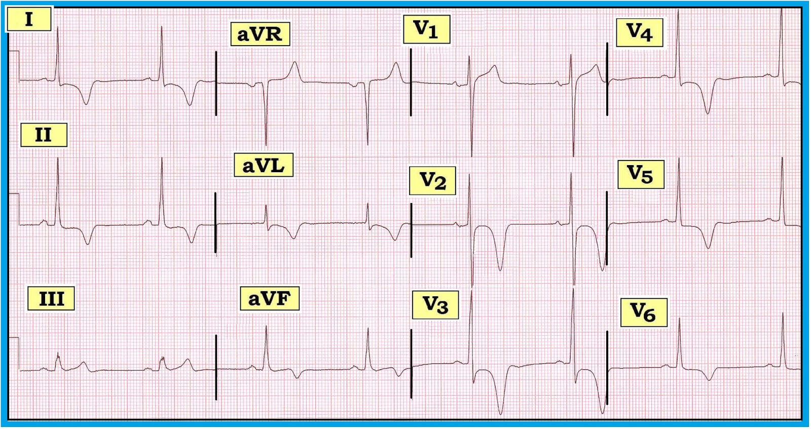 Ecg Interpretation Ecg Interpretation Review 59 T Wave