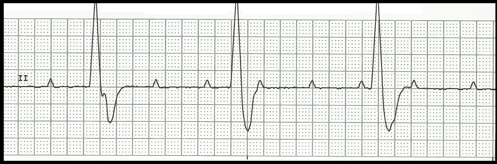 Practice EKG Rhythm Strips 186