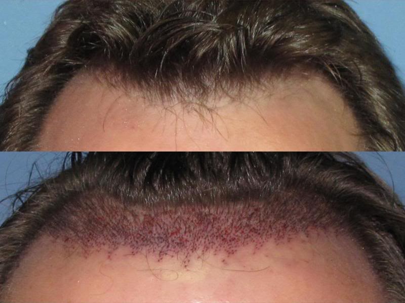 растут ли волосы на шрамах. трансплантация волос hfe. волосы до после. никотиновая кислота для волос на голове. миноксидил генеролон для бороды.