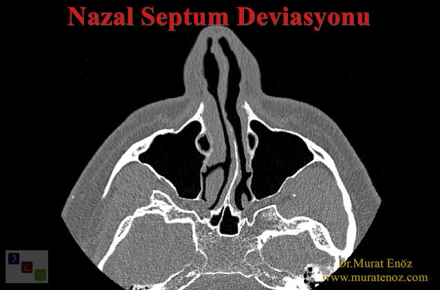 Do nasal tomography is necessary before the septoplasty operation? - Is a paranasal sinus tomography necessary before the septoplasty operation? - Is it necessary to take a nasal tomography before the septum deviation surgery?